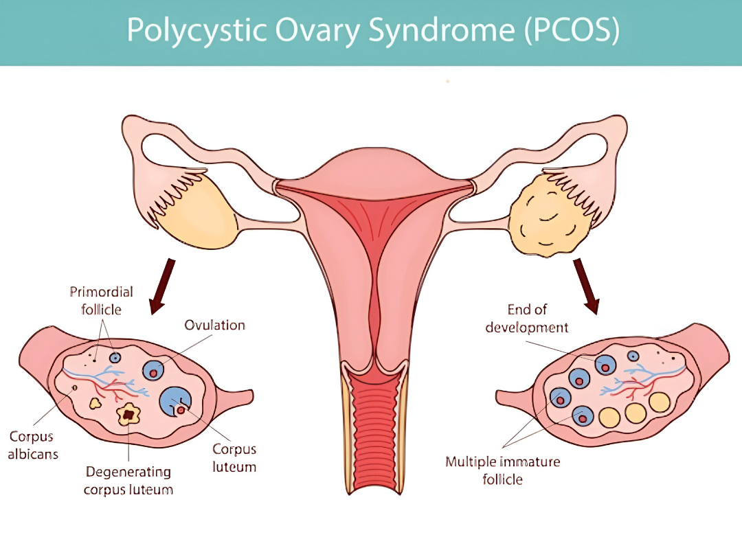 Causes Of Chikangunya
