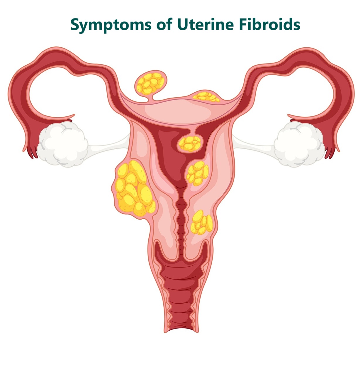 Symptoms of Uterine Fibroids