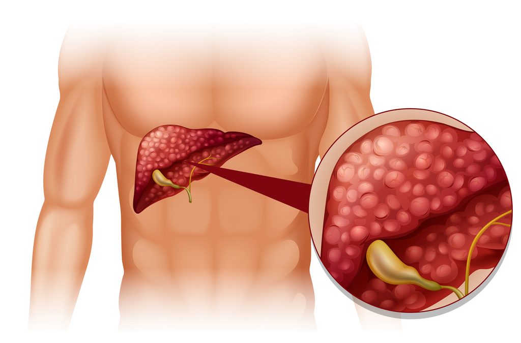 Fatty Liver: Causes, Symptoms, and Lifestyle Changes